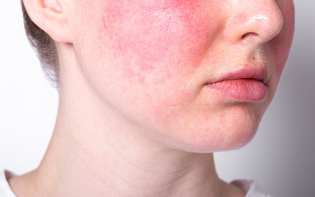 Empfindliche Haut: Anzeichen, Ursachen und Pflegetipps